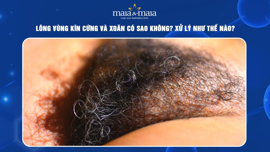 lông vùng kín cứng và xoăn