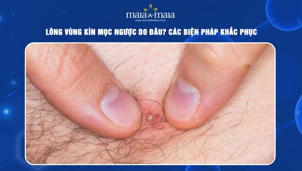 Lông vùng kín mọc ngược
