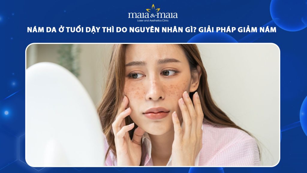 nám da ở tuổi dậy thì