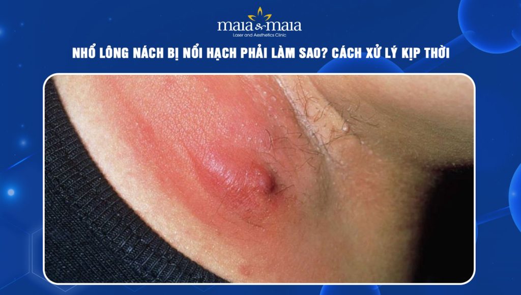 nhổ lông nách bị nổi hạch