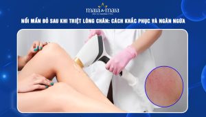 nổi mẩn đỏ sau khi triệt lông chân
