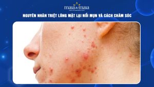 triệt lông mặt lại nổi mụn