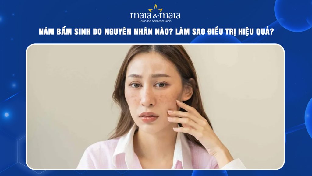 Nám bẩm sinh do nguyên nhân nào? Làm sao điều trị hiệu quả? 1 nám bẩm sinh