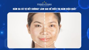 nám da có tự hết không