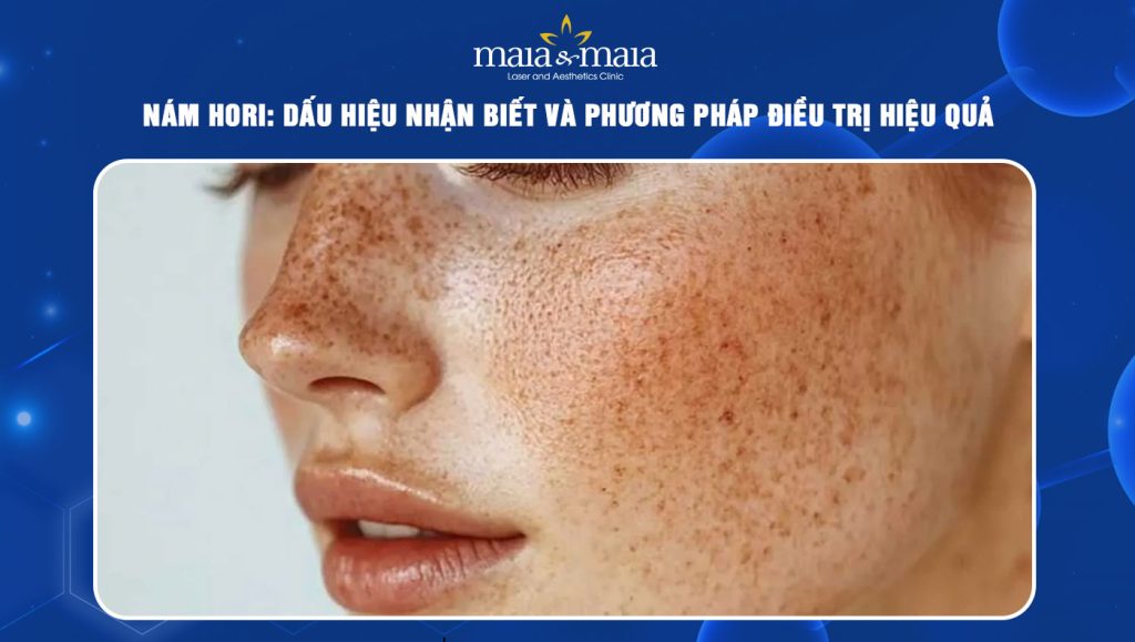 Nám hori: Dấu hiệu nhận biết và phương pháp điều trị hiệu quả 1 nám hori