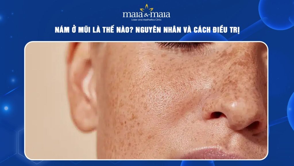 Nám ở mũi là thế nào? Nguyên nhân và cách điều trị 1 nám ở mũi