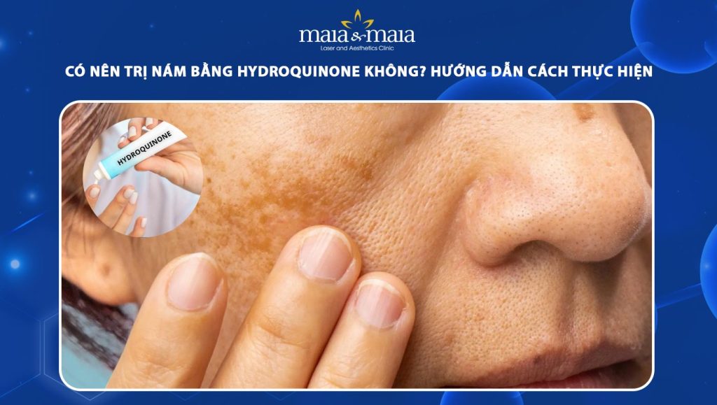 trị nám bằng hydroquinone