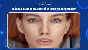 chấm tàn nhang gò má