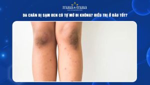 da chân bị sạm đen