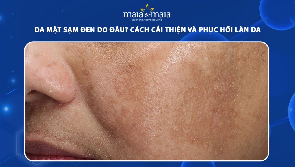Da mặt sạm đen do đâu? Cách cải thiện và phục hồi làn da 1 da mặt sạm đen