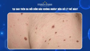 da nổi đốm nâu không ngứa