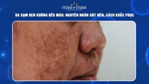 da sạm đen không đều màu