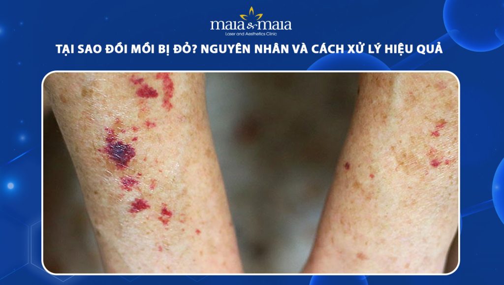 đồi mồi bị đỏ