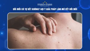 đồi mồi có tự hết không