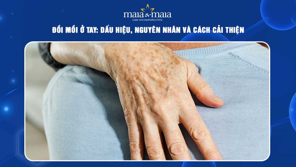 Đồi mồi ở tay: Dấu hiệu, nguyên nhân và cách cải thiện 1 đồi mồi ở tay