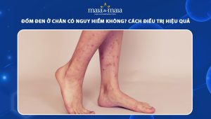 đốm đen ở chân