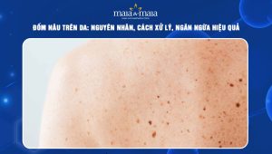 đốm nâu trên da