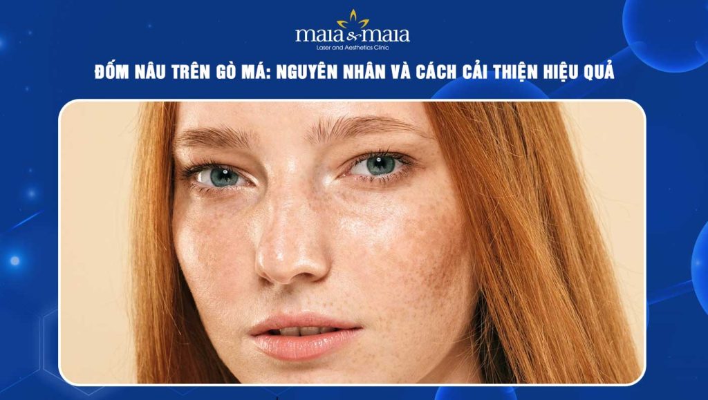 Đốm nâu trên gò má: Nguyên nhân và cách cải thiện hiệu quả 1 đốm nâu trên gò má
