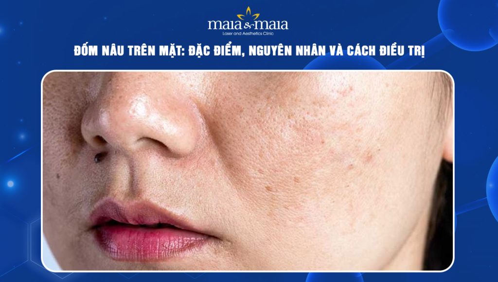 Đốm nâu trên mặt: Đặc điểm, nguyên nhân và cách điều trị 1 đốm nâu trên mặt