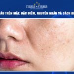 đốm nâu trên mặt