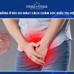 đốm trắng ở bìu