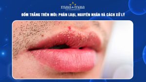 đốm trắng trên môi
