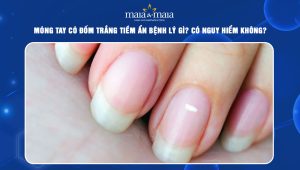 móng tay có đốm trắng