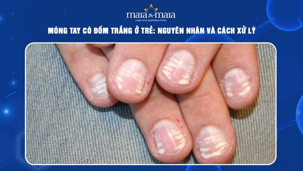 móng tay có đốm trắng ở trẻ