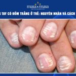 móng tay có đốm trắng ở trẻ