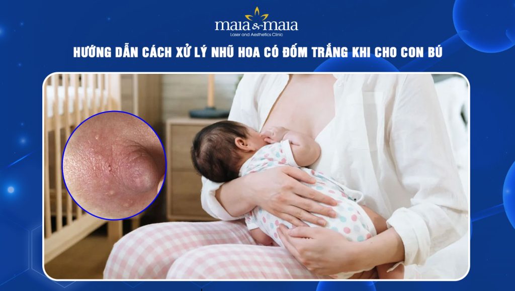 Hướng dẫn cách xử lý nhũ hoa có đốm trắng khi cho con bú 1 nhũ hoa có đốm trắng khi cho con bú