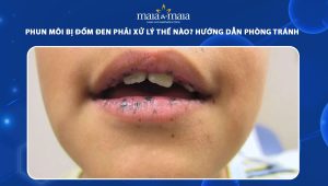 phun môi bị đốm đen