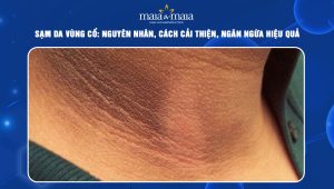 sạm da vùng cổ
