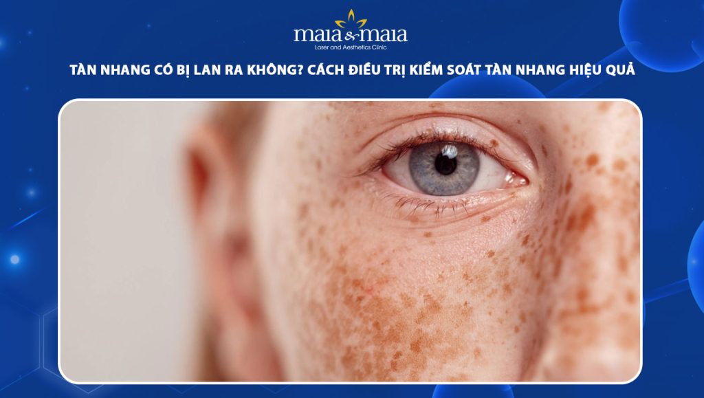Tàn nhang có bị lan ra không? Cách điều trị kiểm soát tàn nhang hiệu quả 1 tàn nhang có bị lan ra không