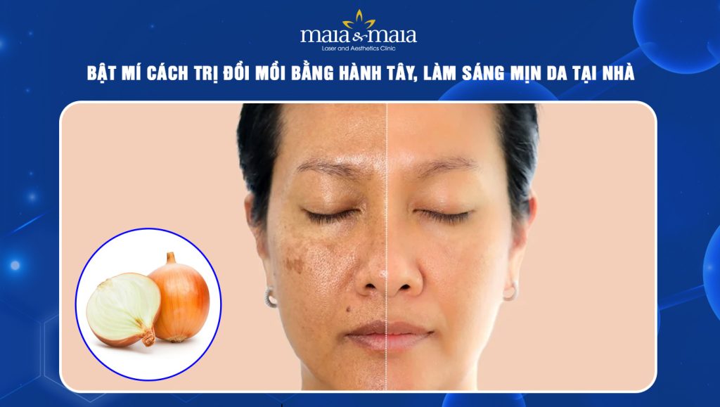 trị đồi mồi bằng hành tây