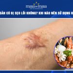 ăn hải sản có bị sẹo lồi không