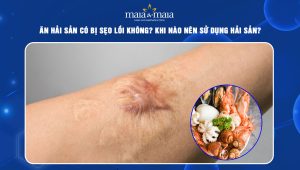 ăn hải sản có bị sẹo lồi không