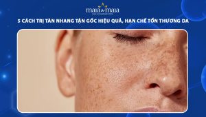 cách trị tàn nhang tận gốc