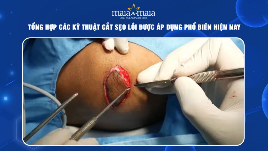 Tổng hợp các kỹ thuật cắt sẹo lồi được áp dụng phổ biến hiện nay 1 cắt sẹo lồi
