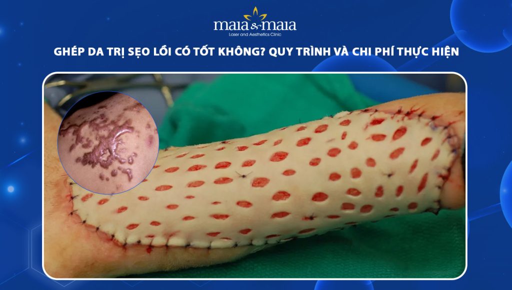 Ghép da trị sẹo lồi có tốt không? Quy trình và chi phí thực hiện 1 ghép da trị sẹo lồi