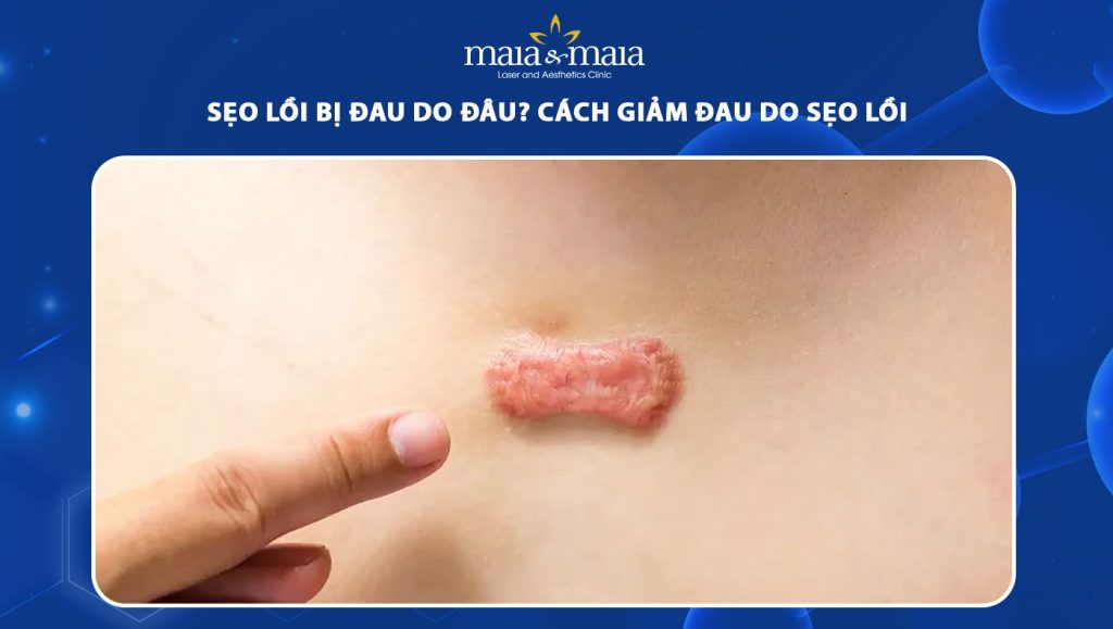 Sẹo lồi bị đau do đâu? Cách giảm đau do sẹo lồi tại nhà 1 sẹo lồi bị đau