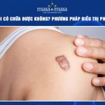 sẹo lồi có chữa được không