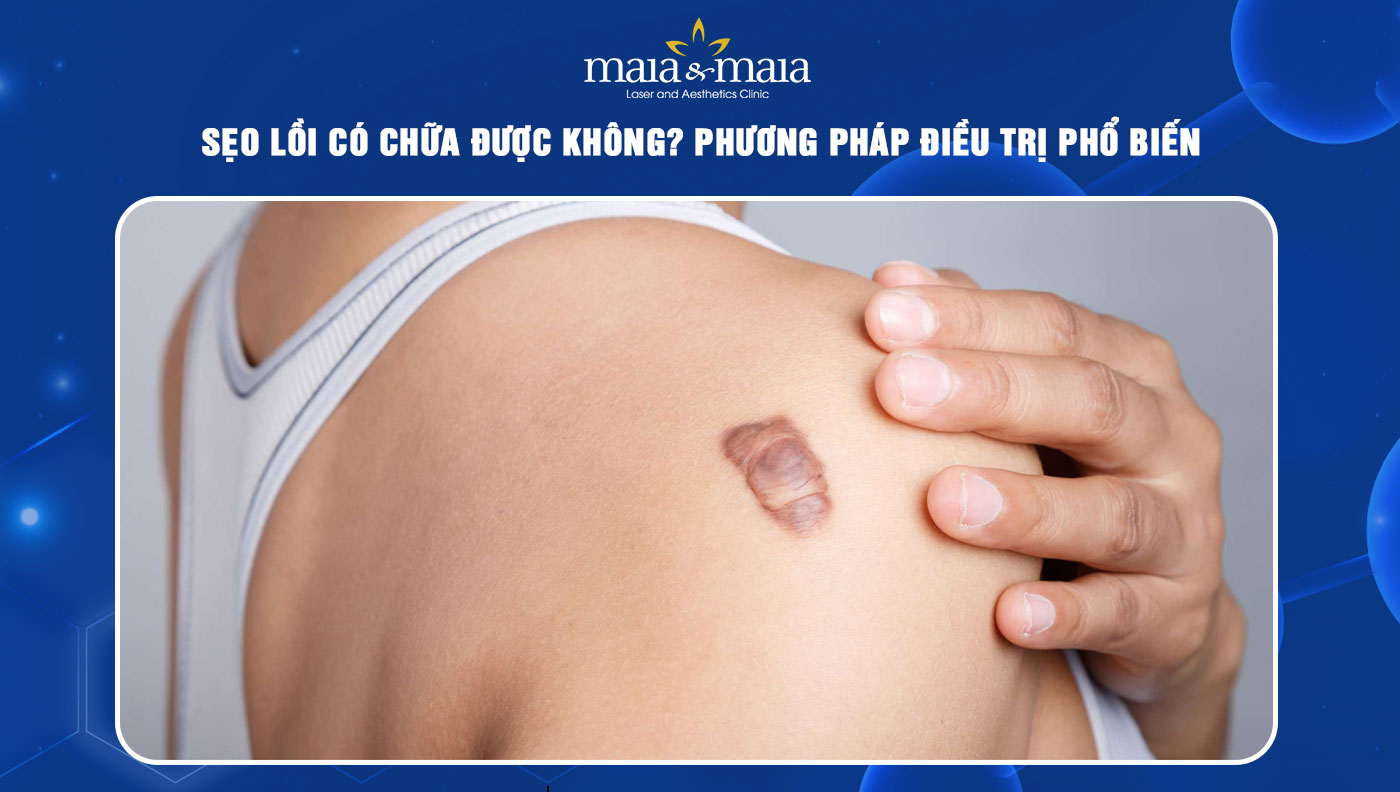 sẹo lồi có chữa được không