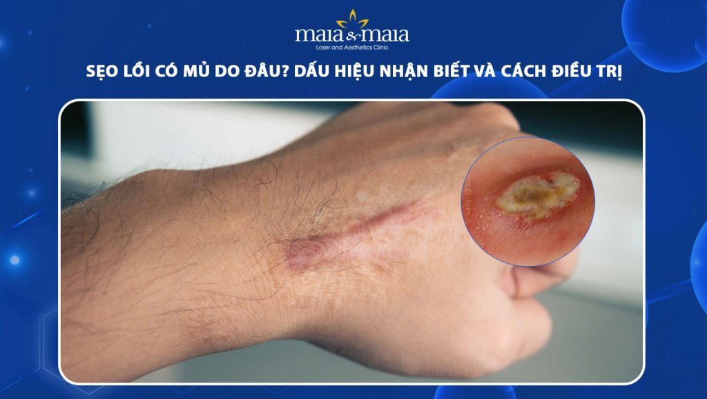 Sẹo lồi có mủ do đâu? Dấu hiệu nhận biết và cách điều trị 1 sẹo lồi có mủ