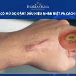 sẹo lồi có mủ