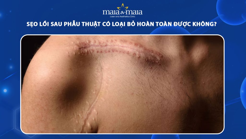 sẹo lồi sau phẫu thuật