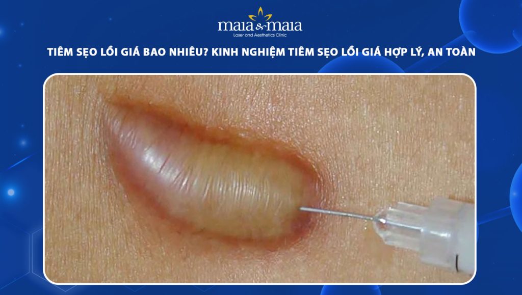 Tiêm sẹo lồi giá bao nhiêu? Kinh nghiệm tiêm sẹo lồi giá hợp lý, an toàn 1 tiêm sẹo lồi giá bao nhiêu
