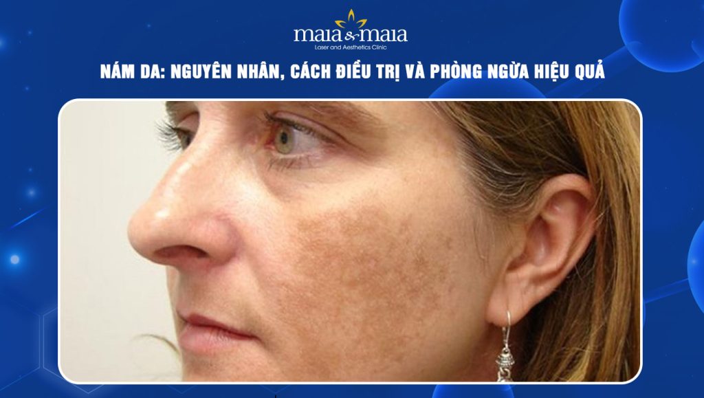 Nám da: Nguyên nhân, cách điều trị và phòng ngừa hiệu quả 1 vết nám da