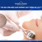 cà da mặt trị sẹo lõm