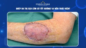 ghép da trị sẹo lõm