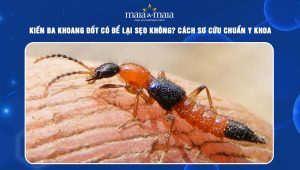 kiến ba khoang đốt có để lại sẹo không